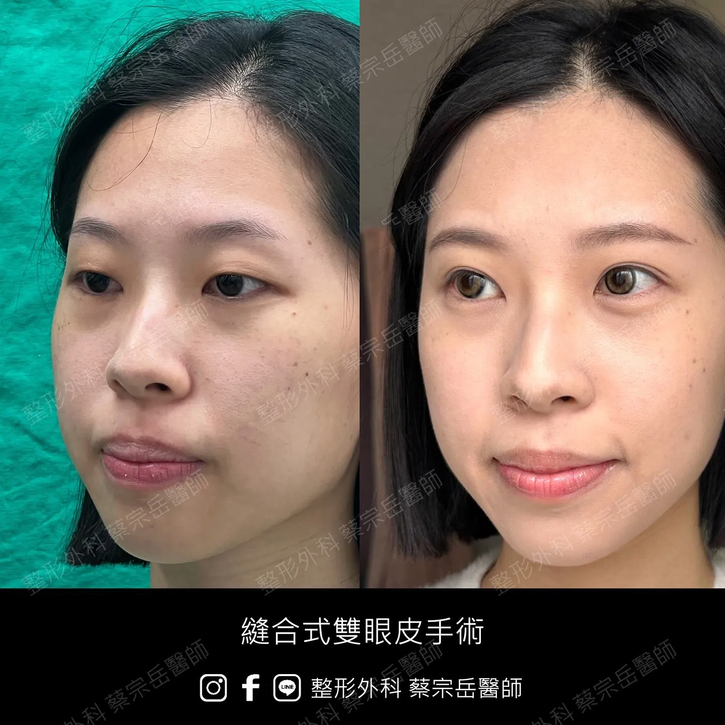 縫合式雙眼皮手術