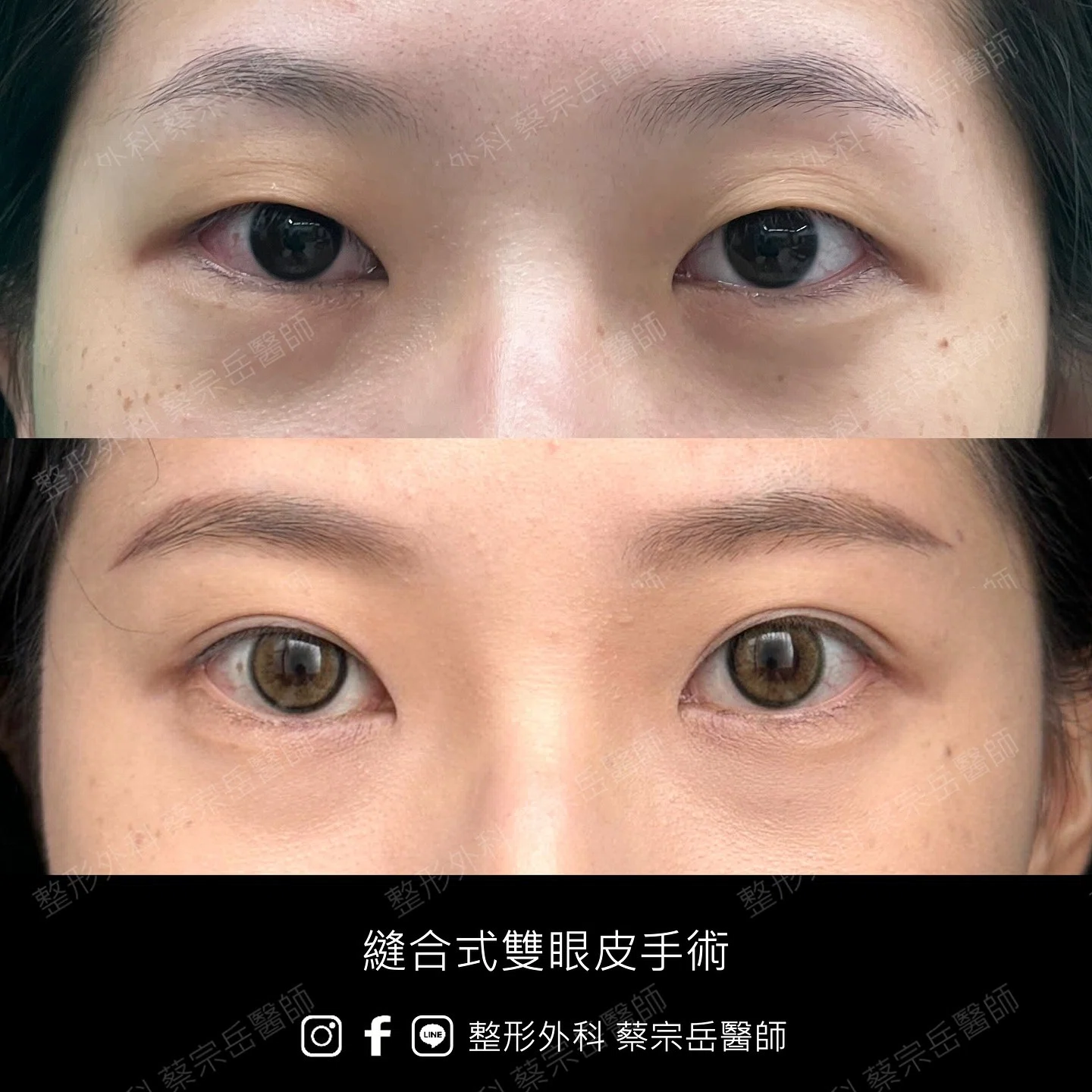 縫合式雙眼皮手術
