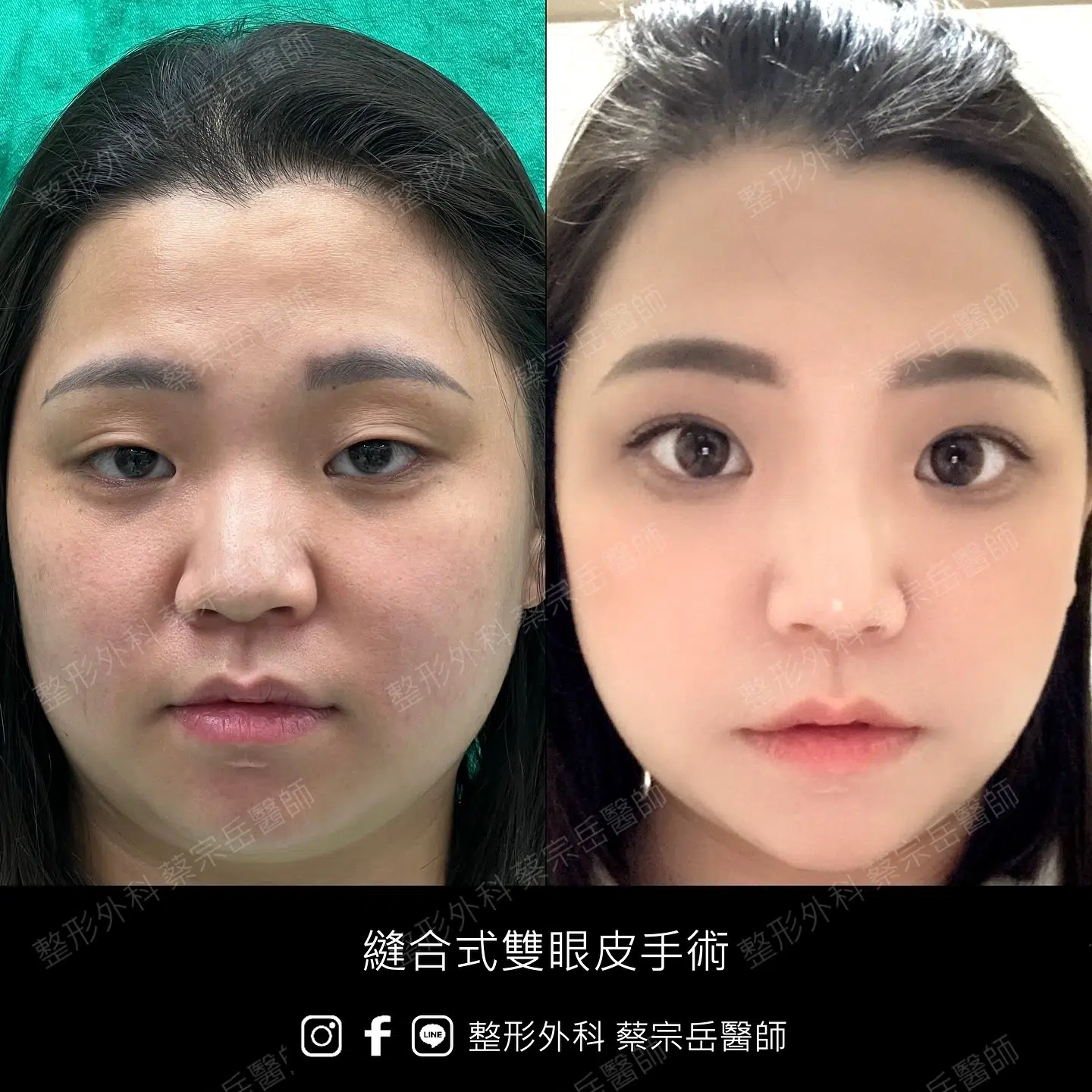 縫合式雙眼皮手術