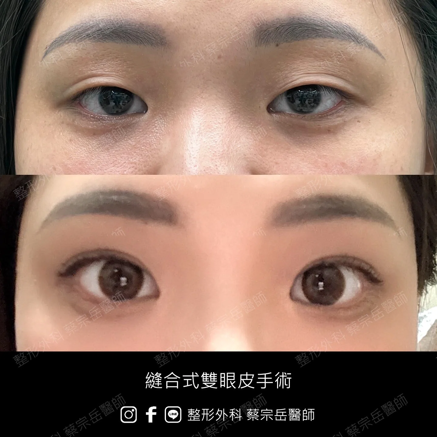 縫合式雙眼皮手術