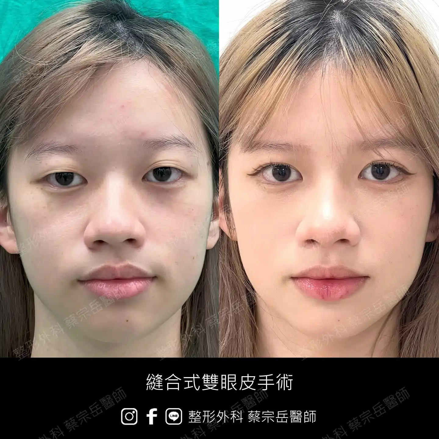 縫合式雙眼皮手術