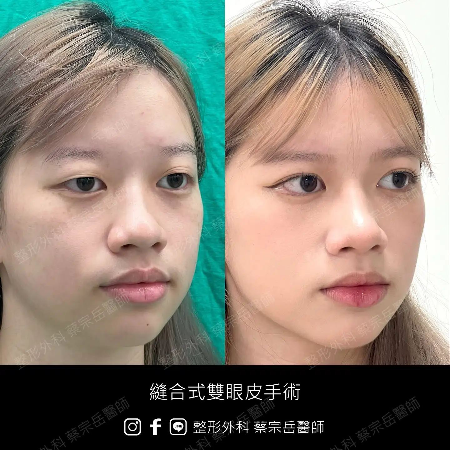 縫合式雙眼皮手術