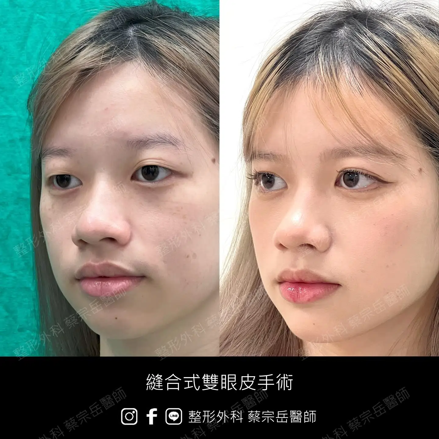 縫合式雙眼皮手術