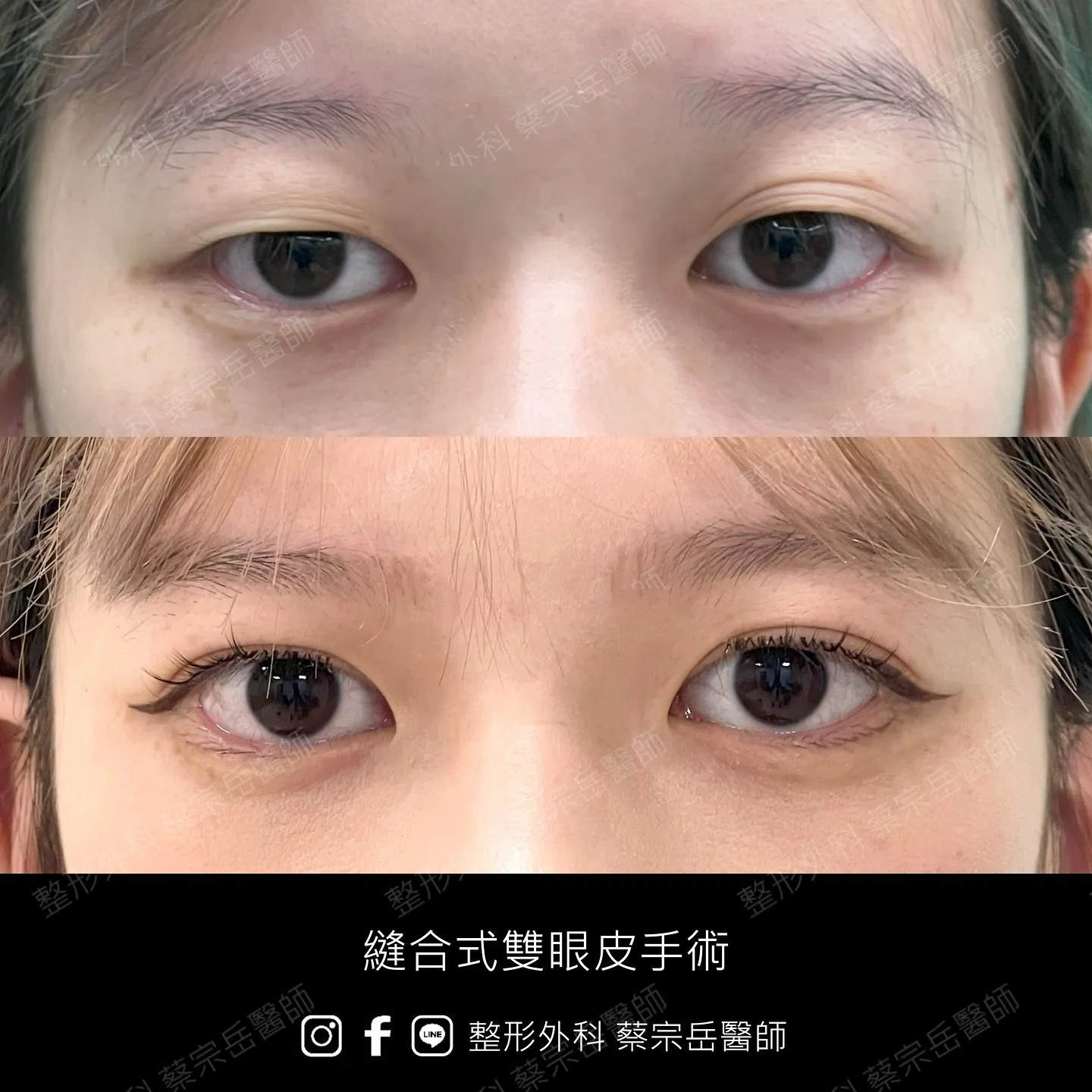 縫合式雙眼皮手術