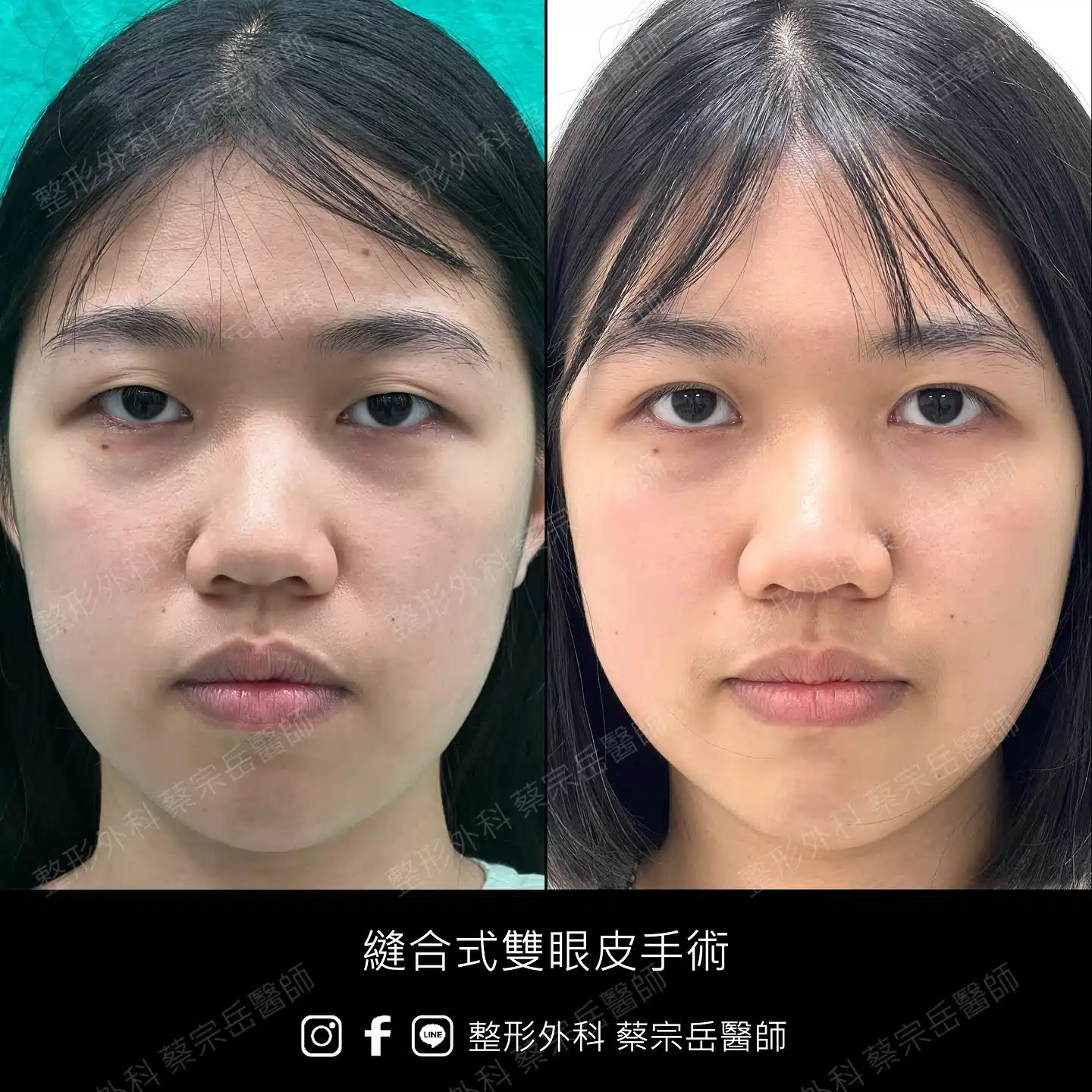 縫合式雙眼皮手術