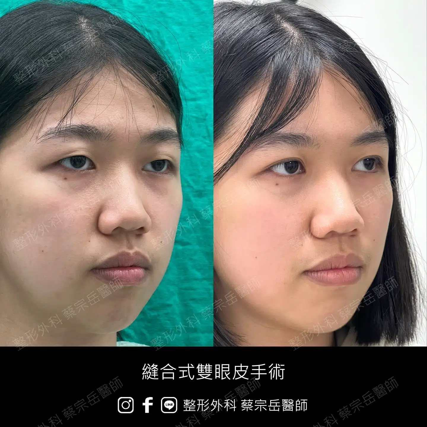 縫合式雙眼皮手術