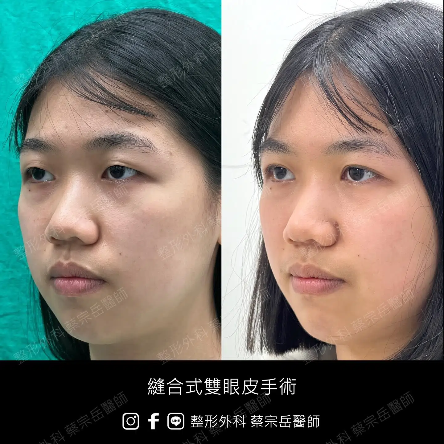 縫合式雙眼皮手術