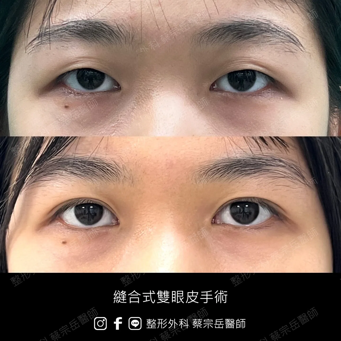 縫合式雙眼皮手術