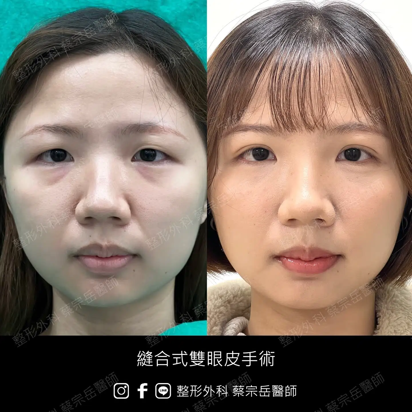 縫合式雙眼皮手術