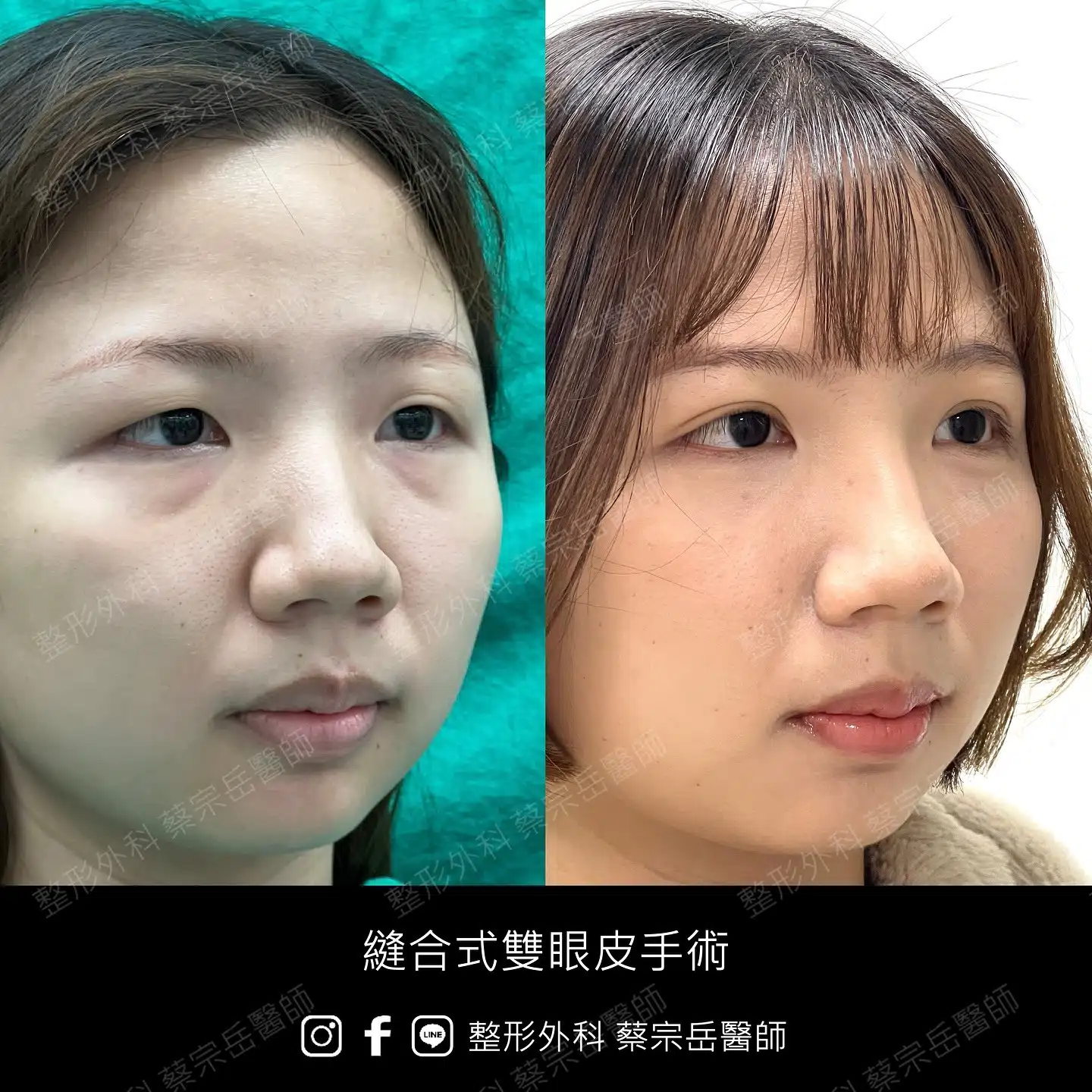 縫合式雙眼皮手術