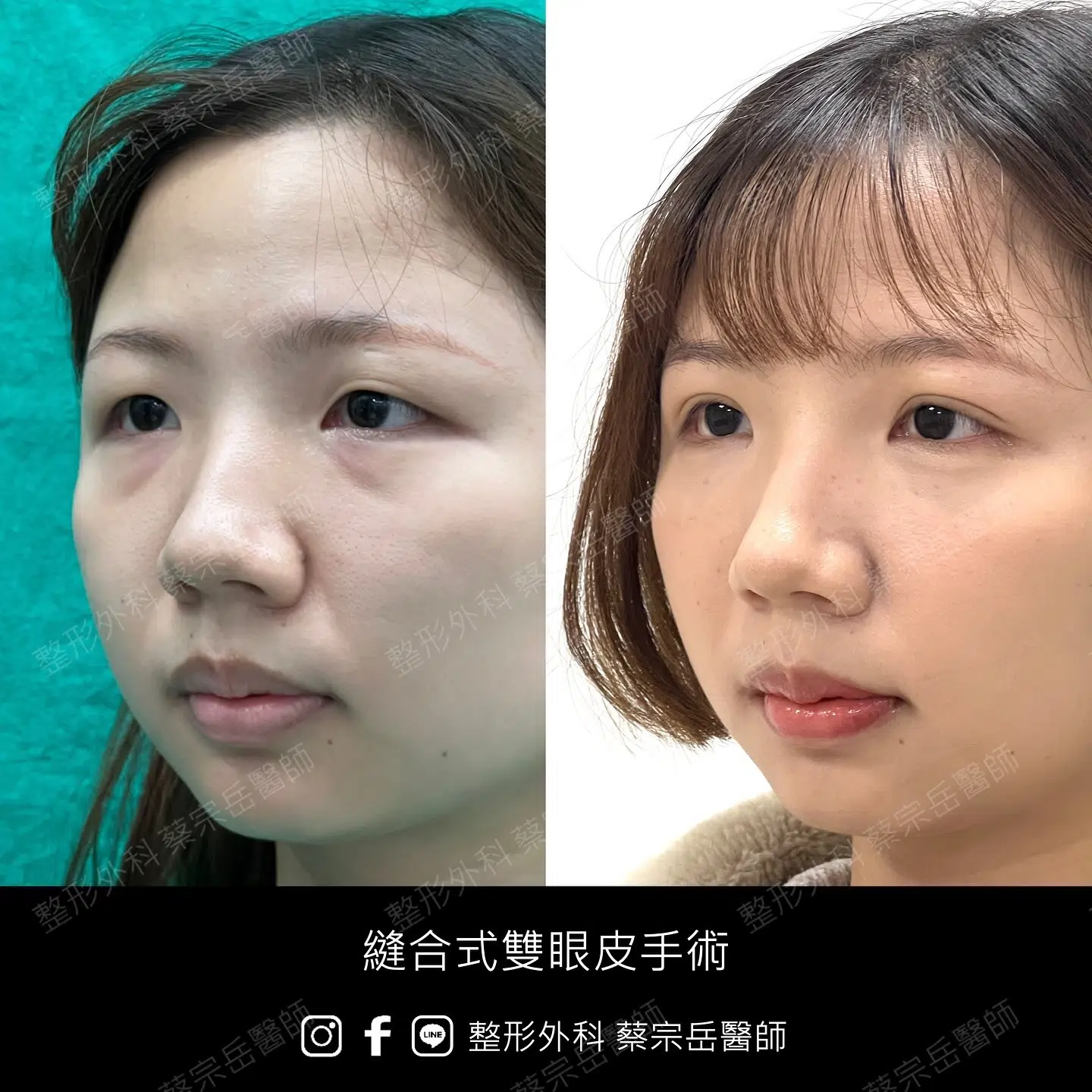 縫合式雙眼皮手術