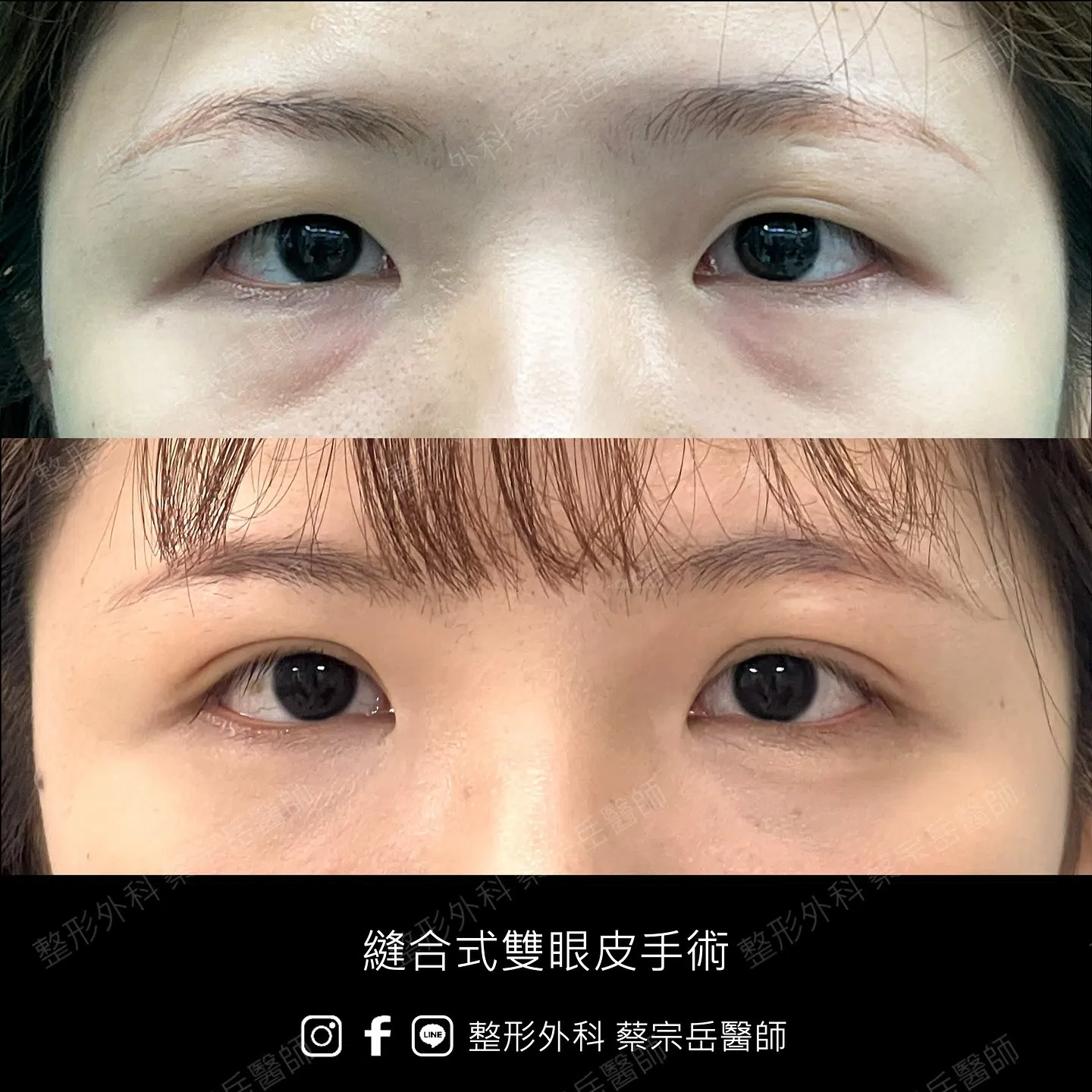 縫合式雙眼皮手術
