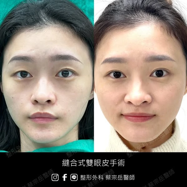 縫合式雙眼皮手術
