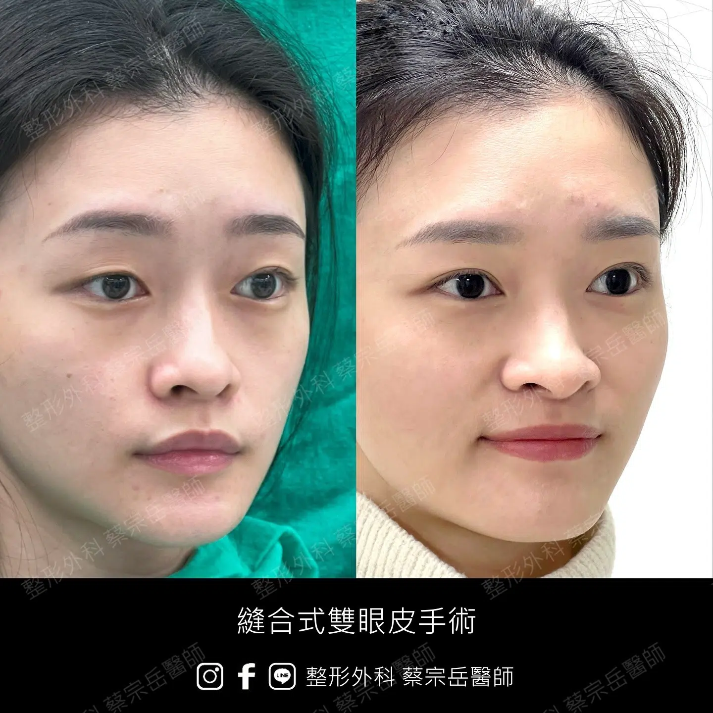 縫合式雙眼皮手術