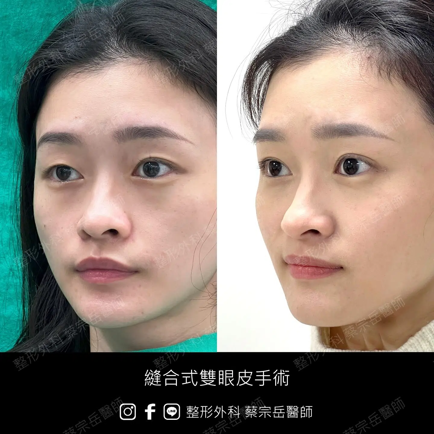 縫合式雙眼皮手術