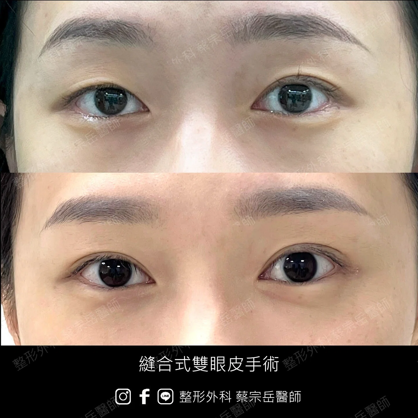 縫合式雙眼皮手術