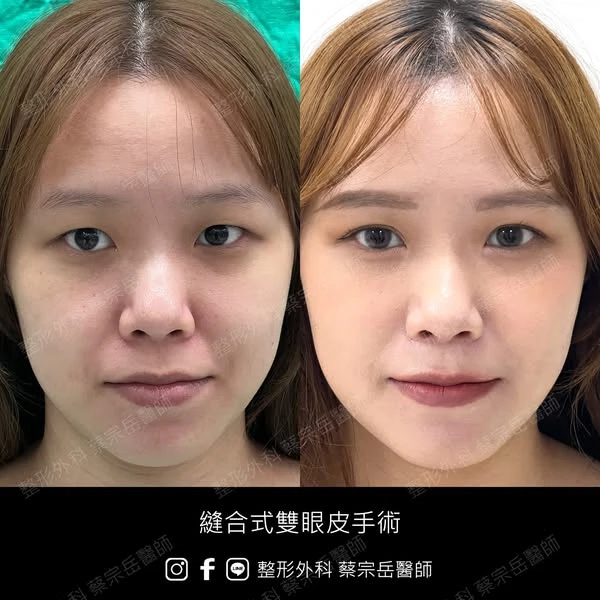 縫合式雙眼皮手術