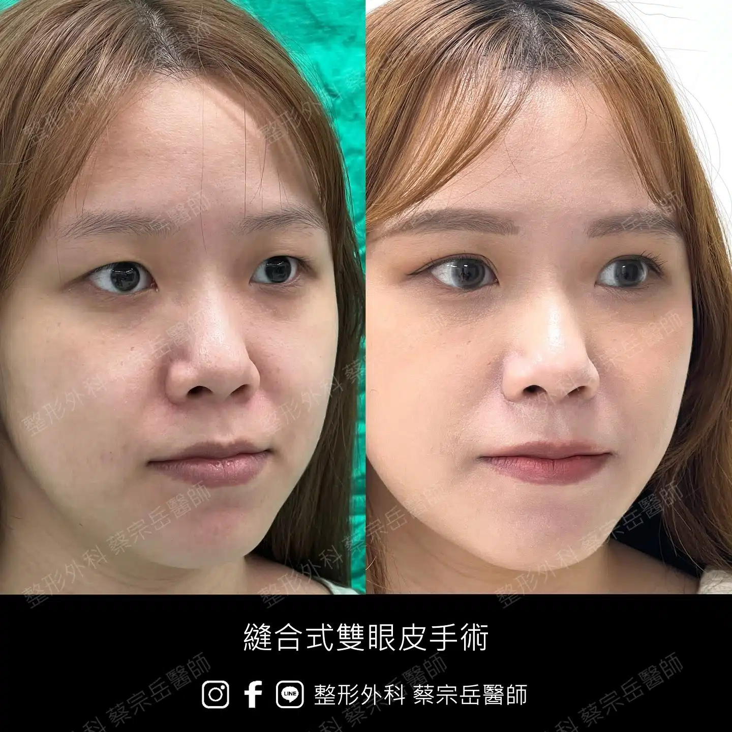 縫合式雙眼皮手術