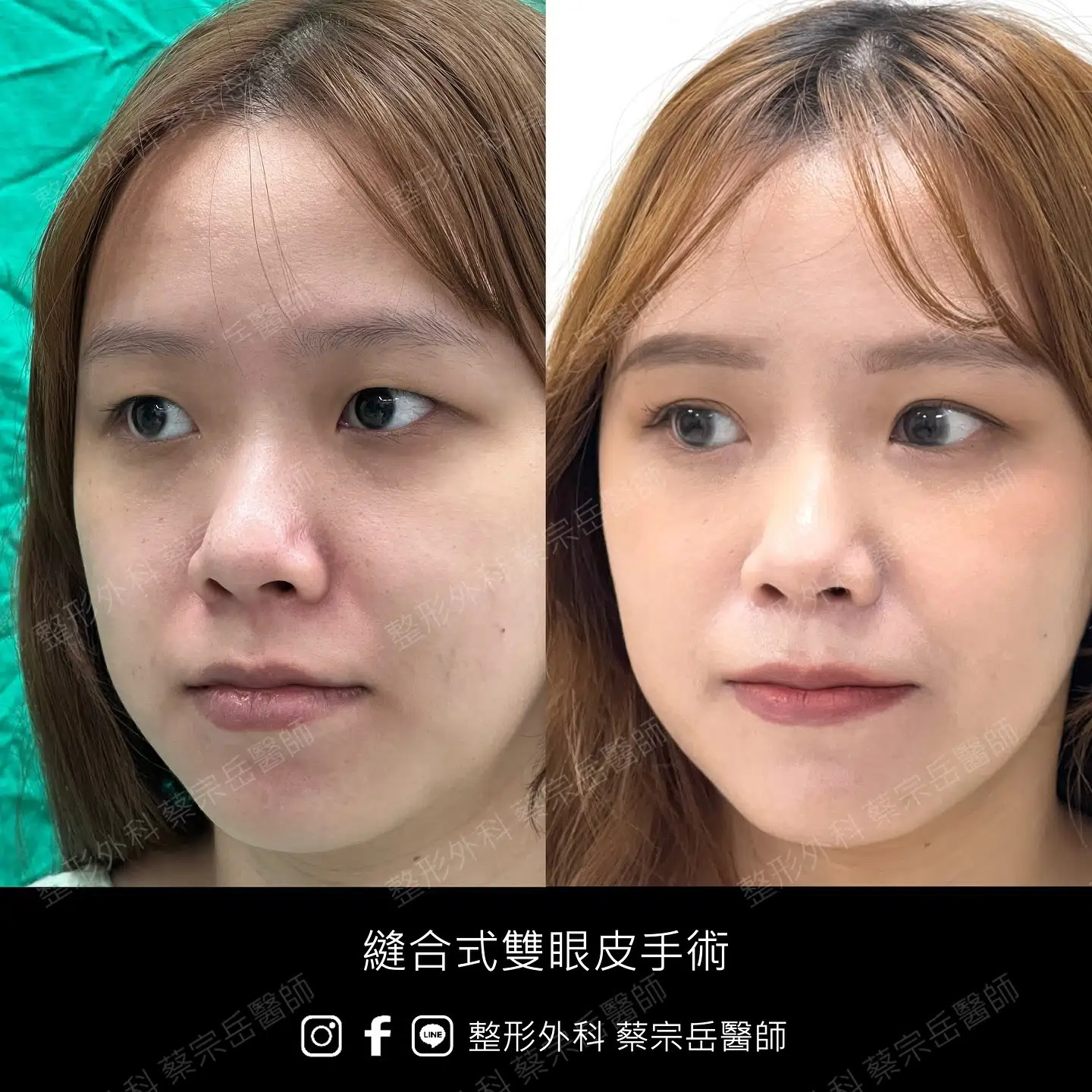 縫合式雙眼皮手術