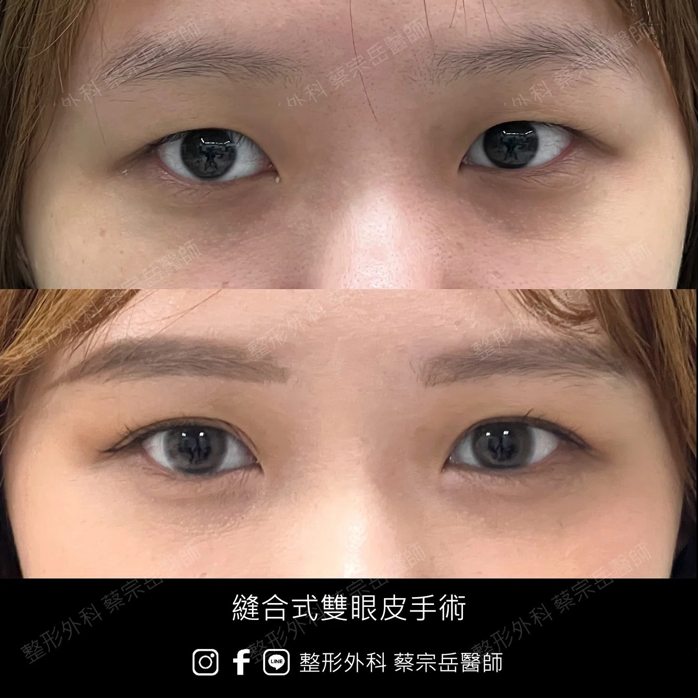 縫合式雙眼皮手術