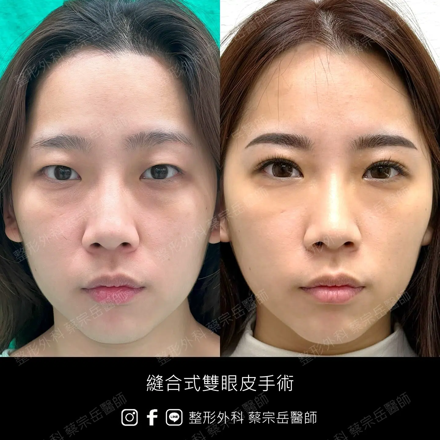 縫合式雙眼皮手術