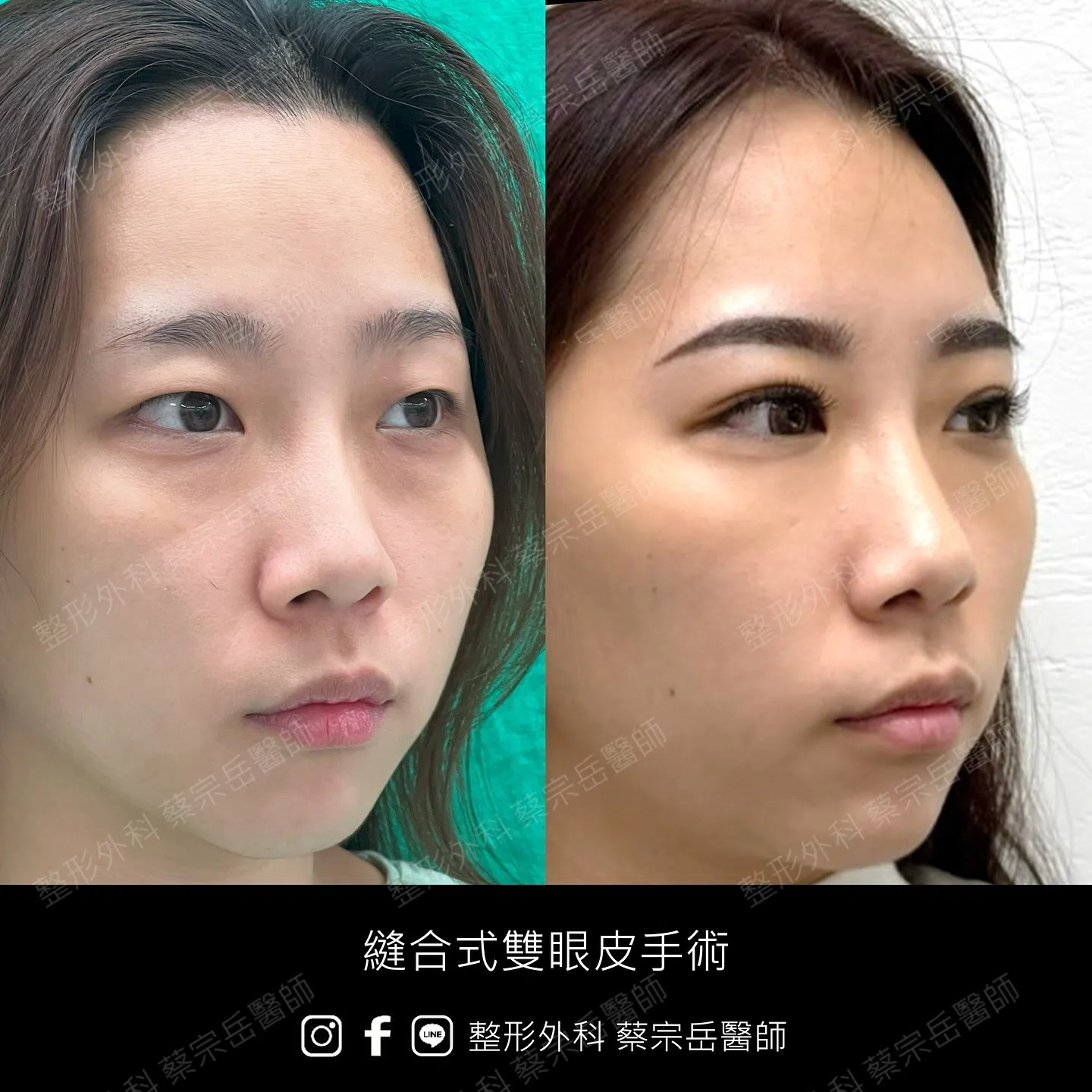 縫合式雙眼皮手術