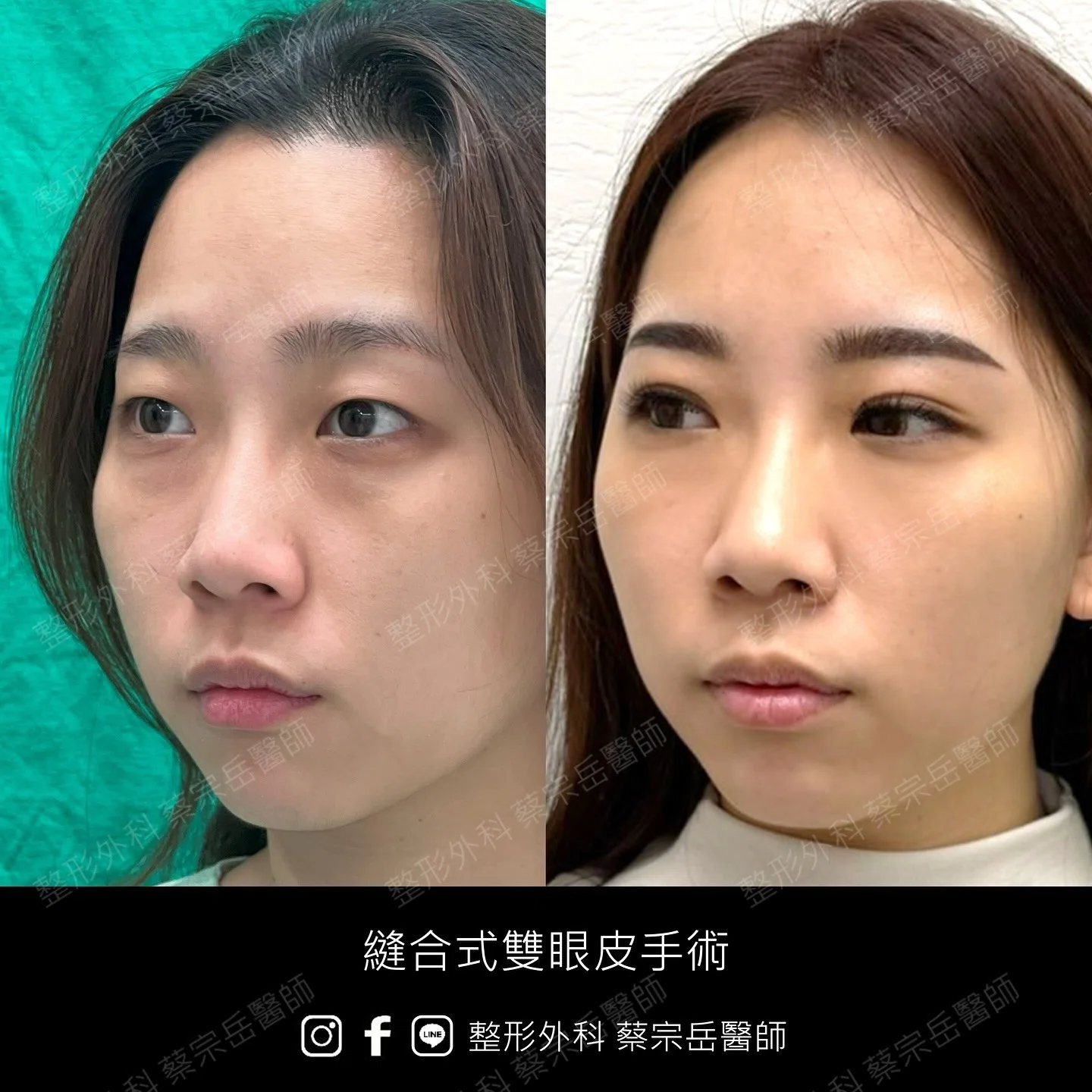 縫合式雙眼皮手術