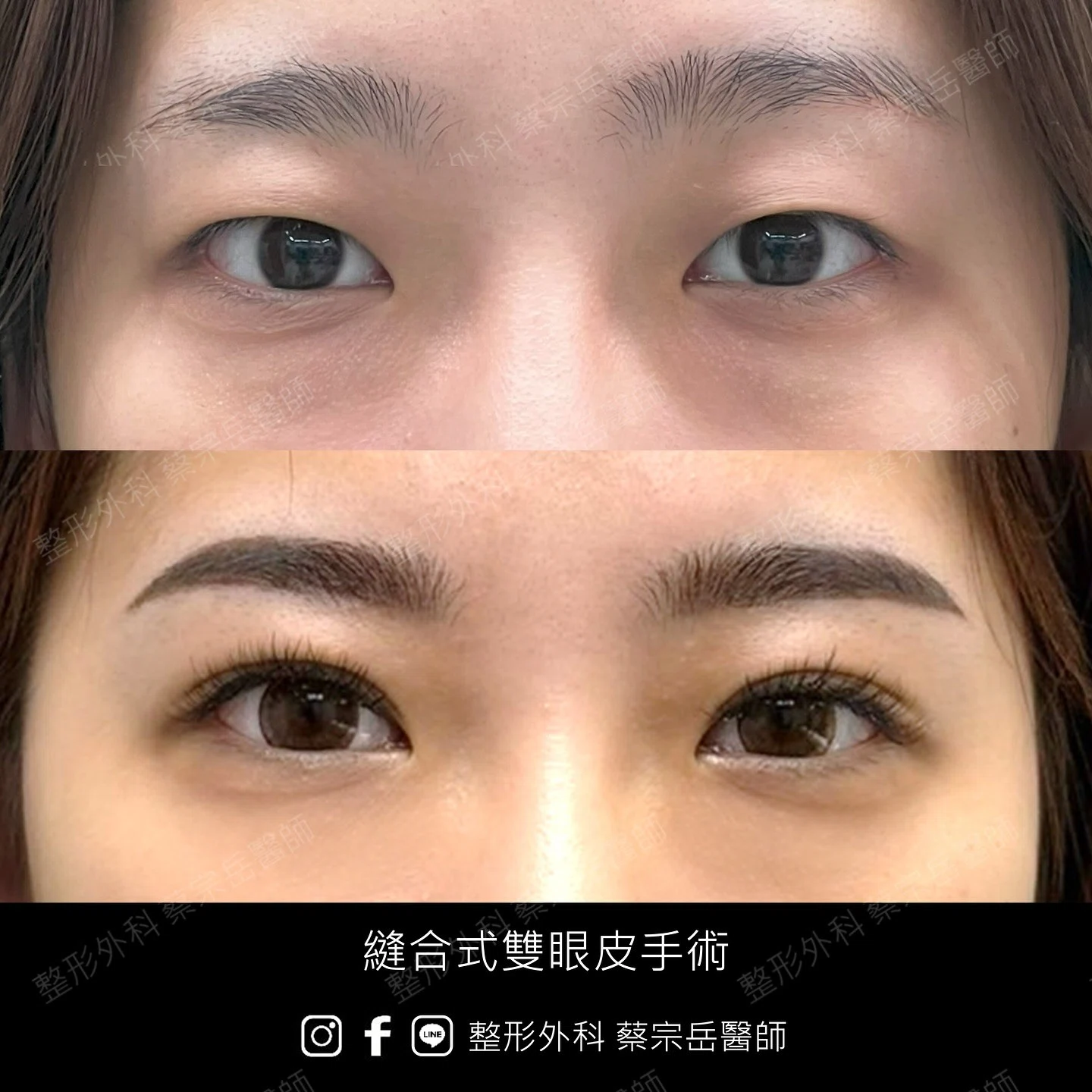 縫合式雙眼皮手術
