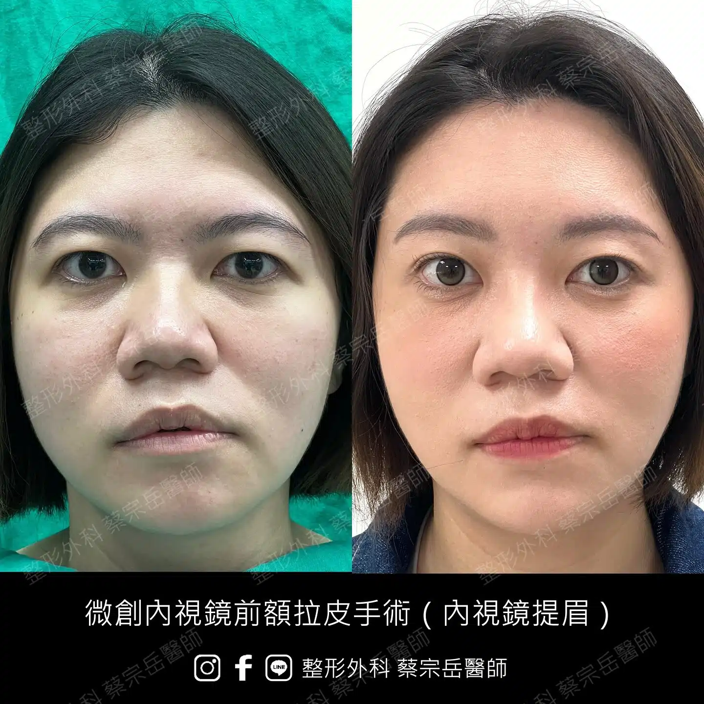 縫合式雙眼皮手術