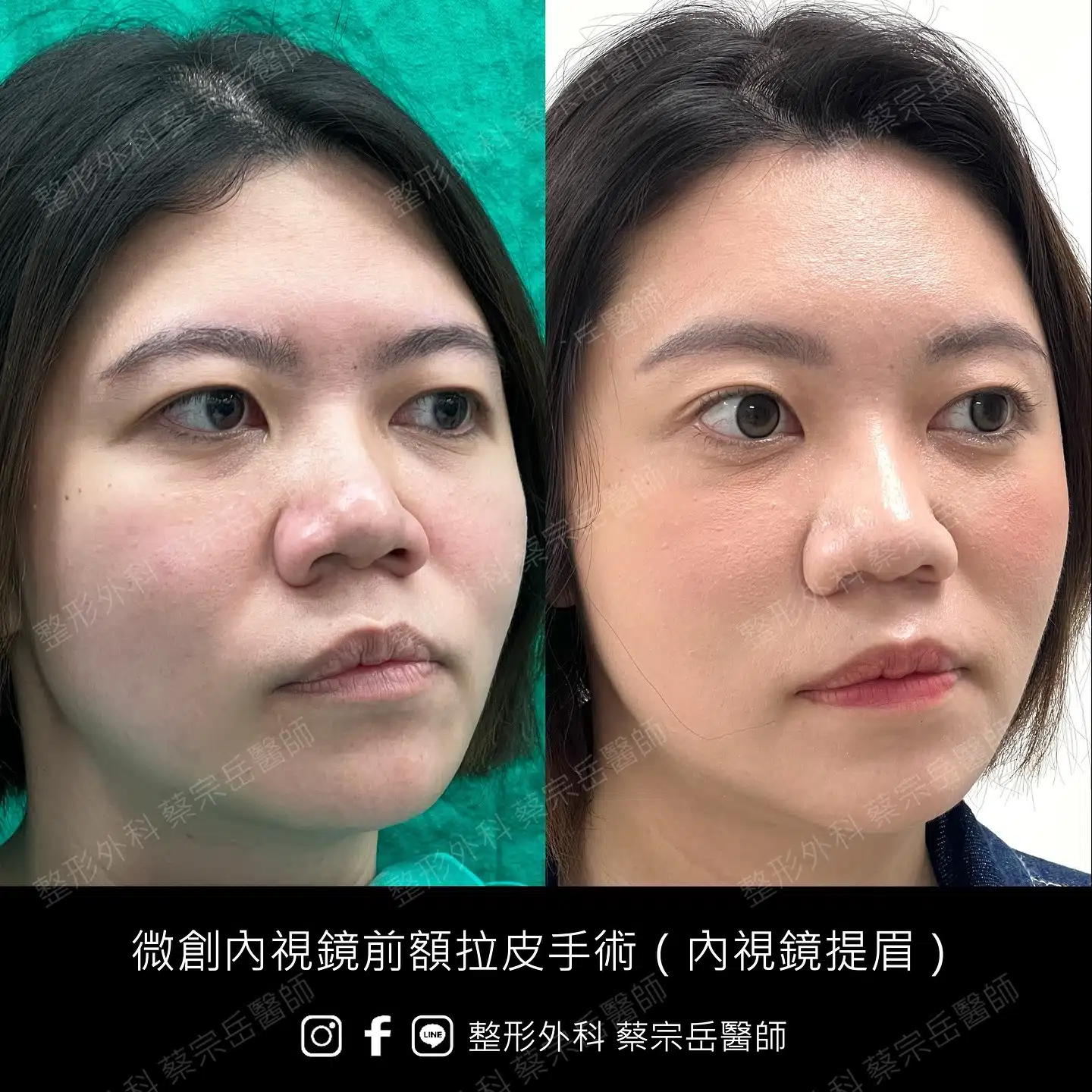 縫合式雙眼皮手術