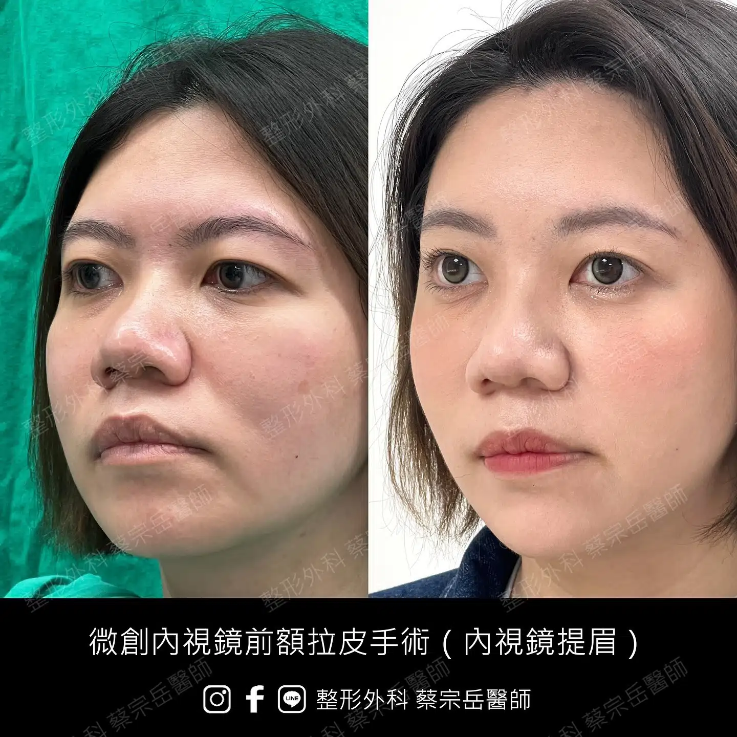 縫合式雙眼皮手術