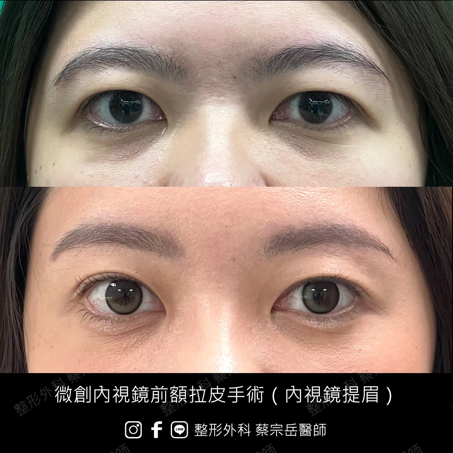 縫合式雙眼皮手術