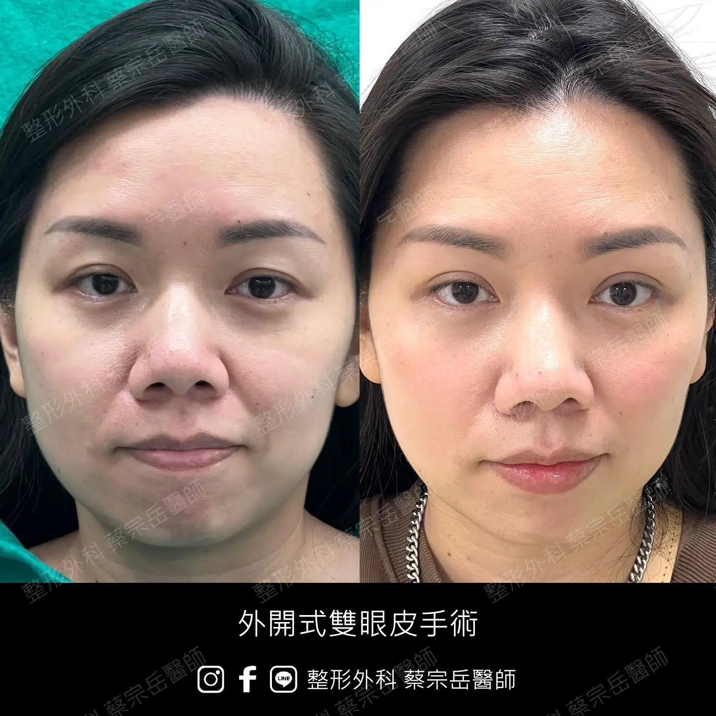 縫合式雙眼皮手術