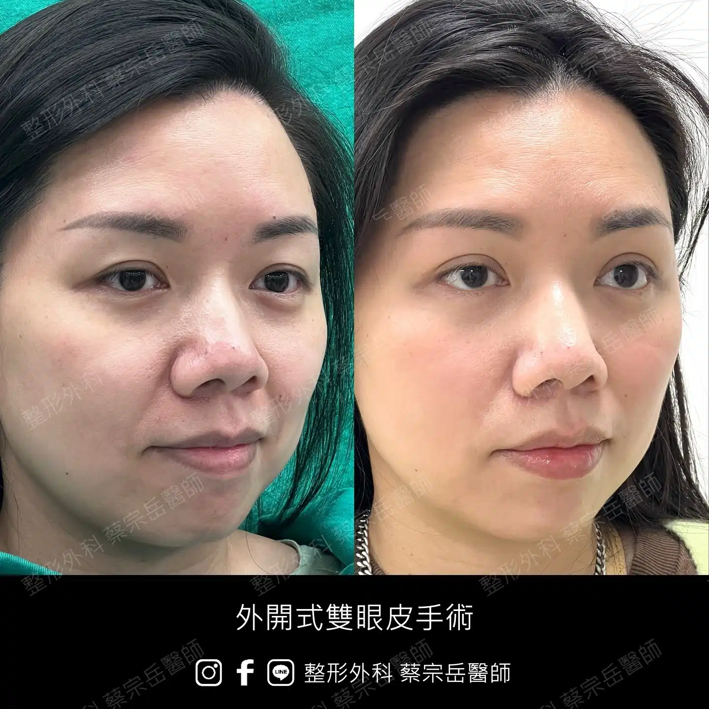 縫合式雙眼皮手術