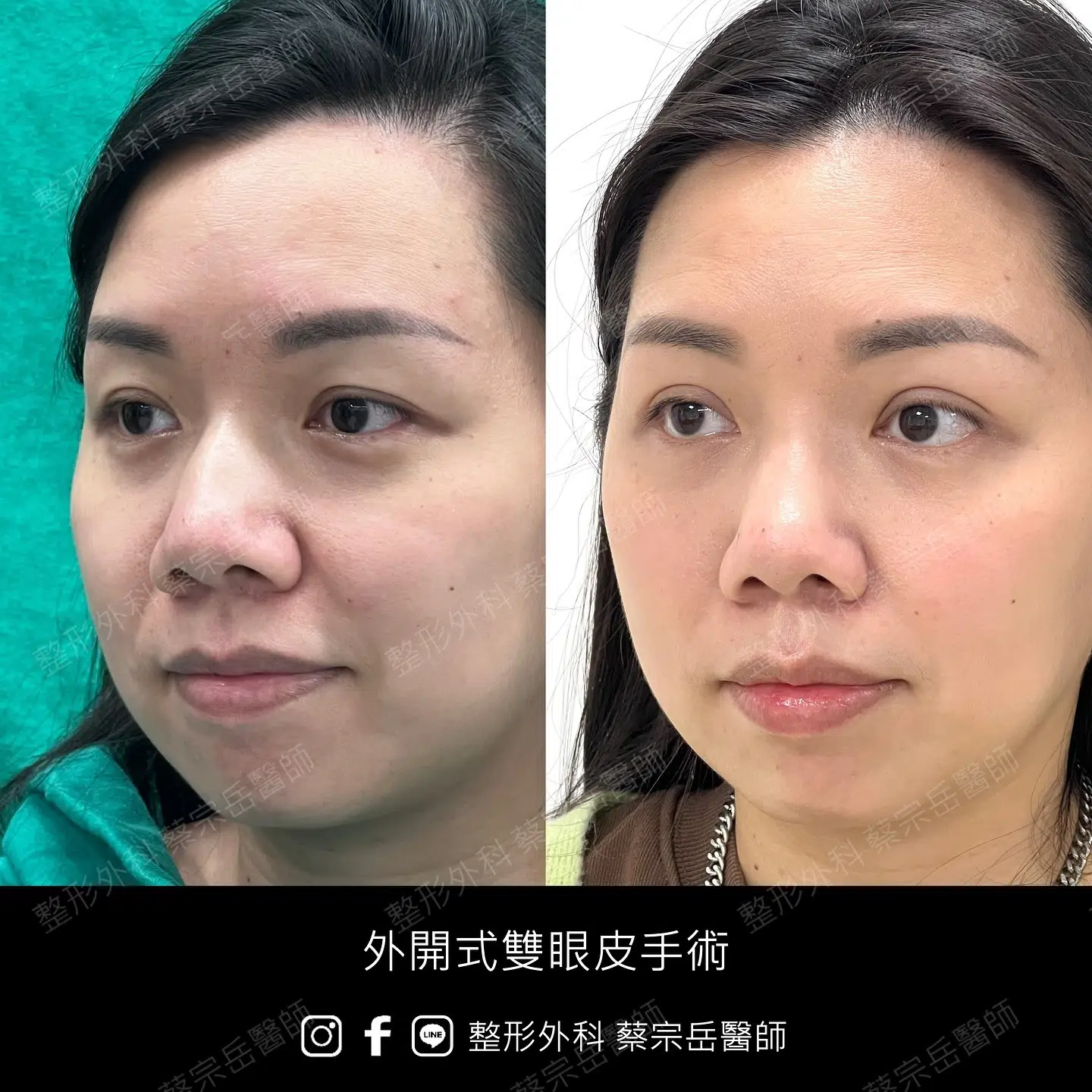 縫合式雙眼皮手術