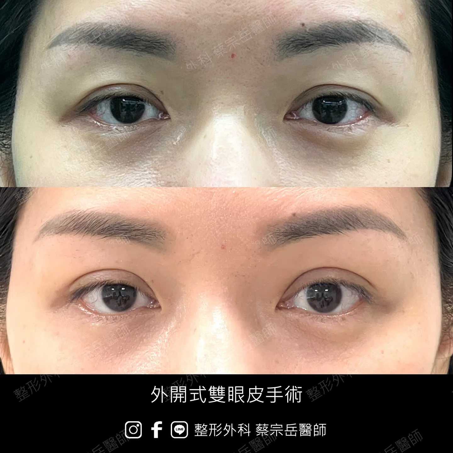 縫合式雙眼皮手術