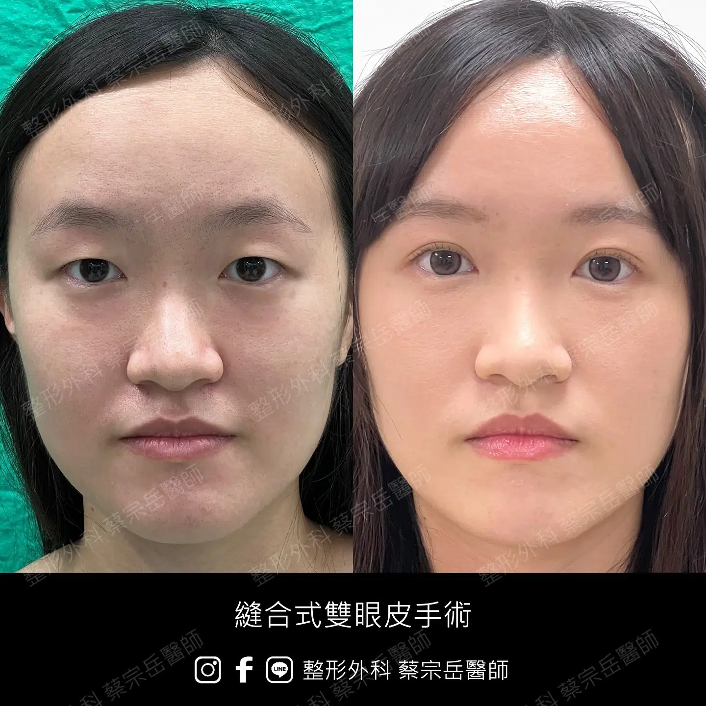 縫合式雙眼皮手術