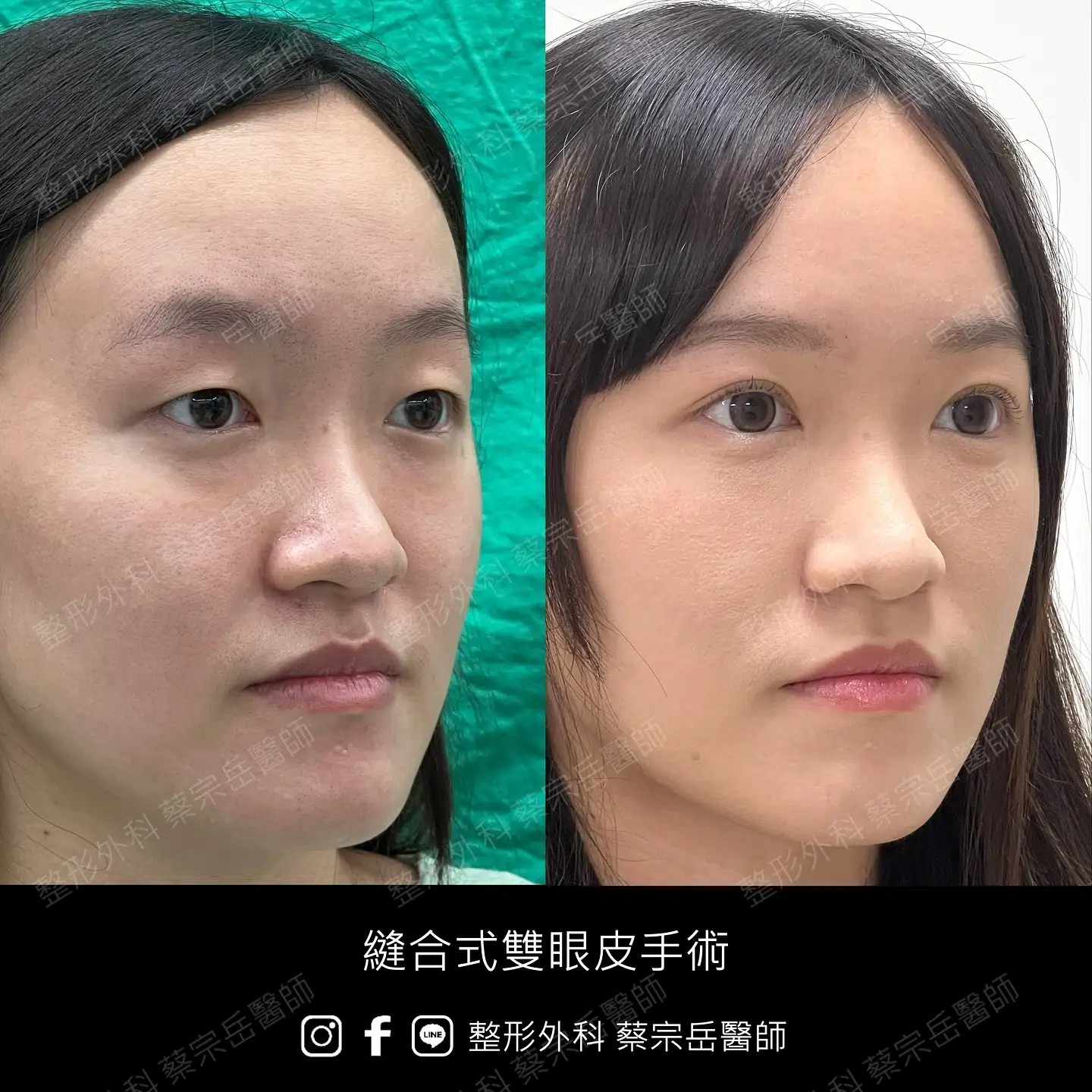 縫合式雙眼皮手術