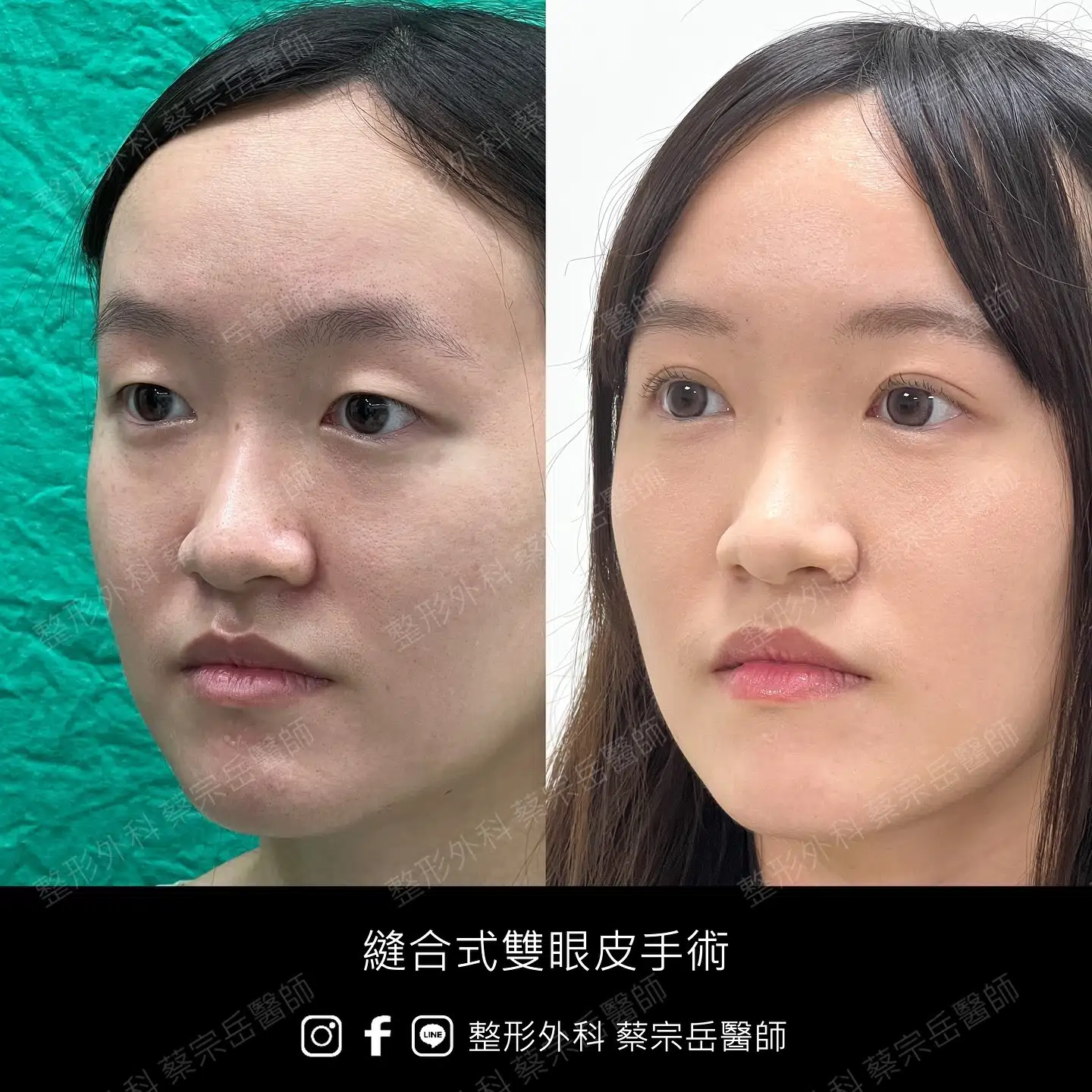 縫合式雙眼皮手術