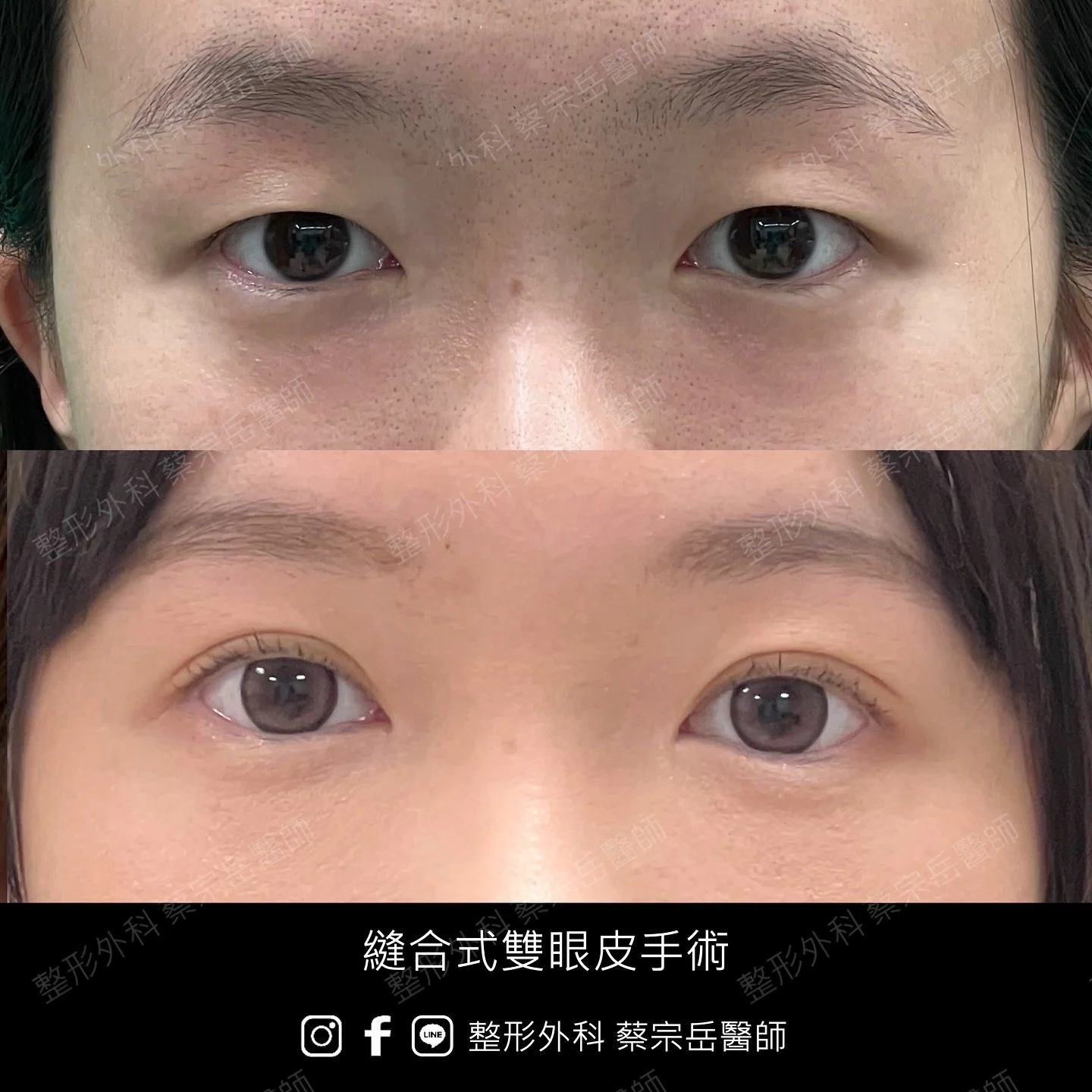 縫合式雙眼皮手術
