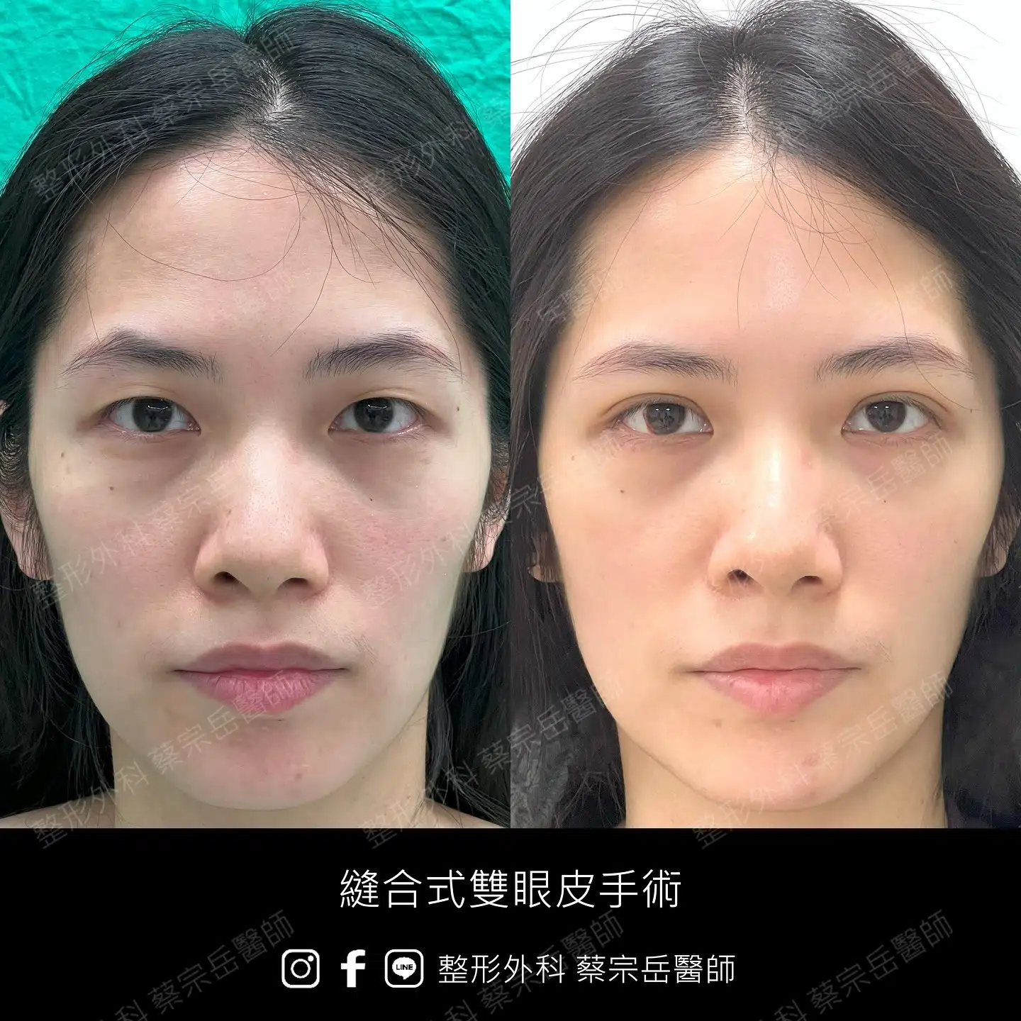 縫合式雙眼皮手術