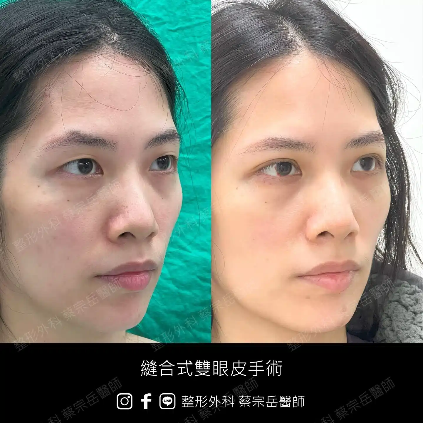 縫合式雙眼皮手術