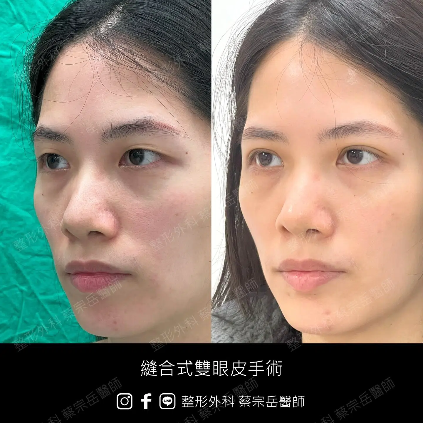 縫合式雙眼皮手術