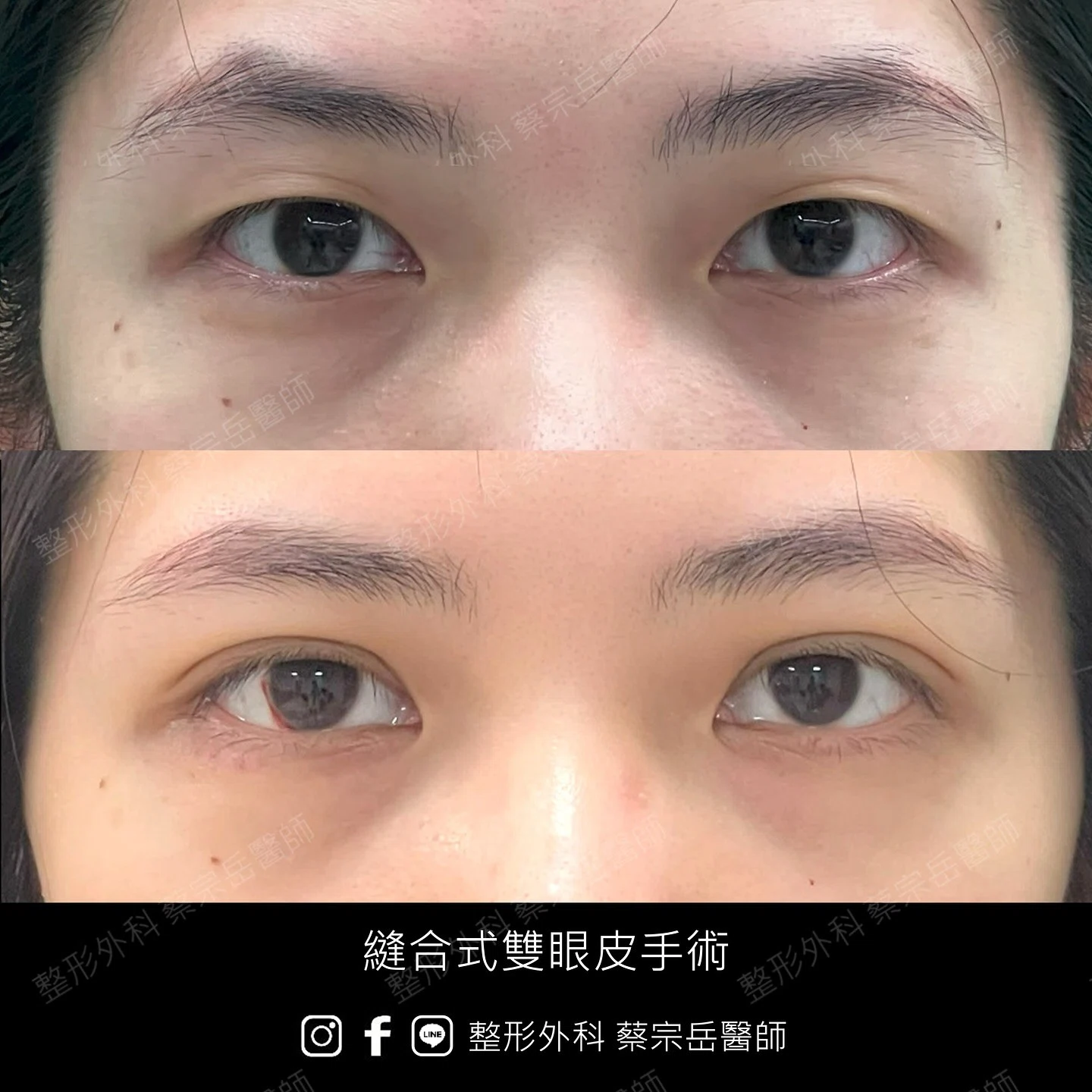 縫合式雙眼皮手術