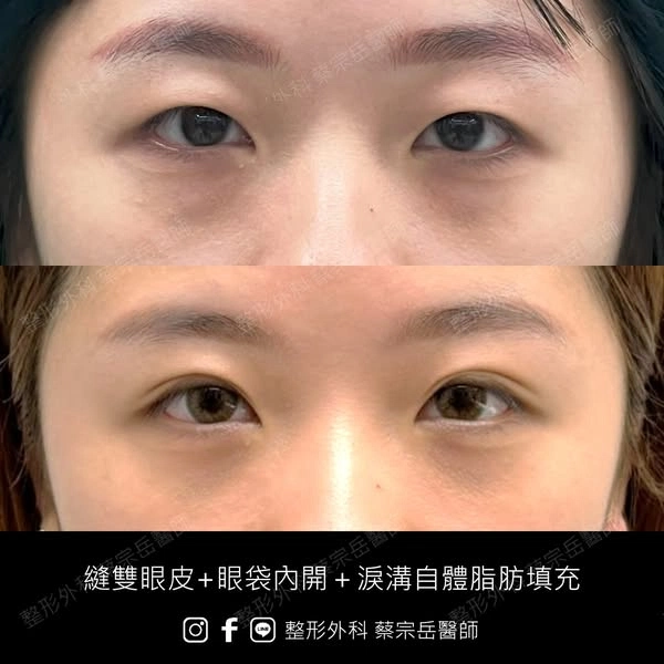 縫雙眼皮+眼袋內開+淚溝自體脂肪填充