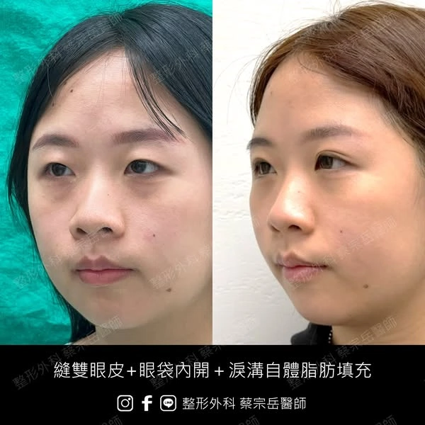 縫雙眼皮+眼袋內開+淚溝自體脂肪填充