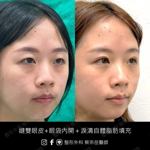 縫雙眼皮+眼袋內開+淚溝自體脂肪填充