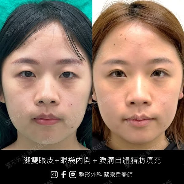 縫雙眼皮+眼袋內開+淚溝自體脂肪填充