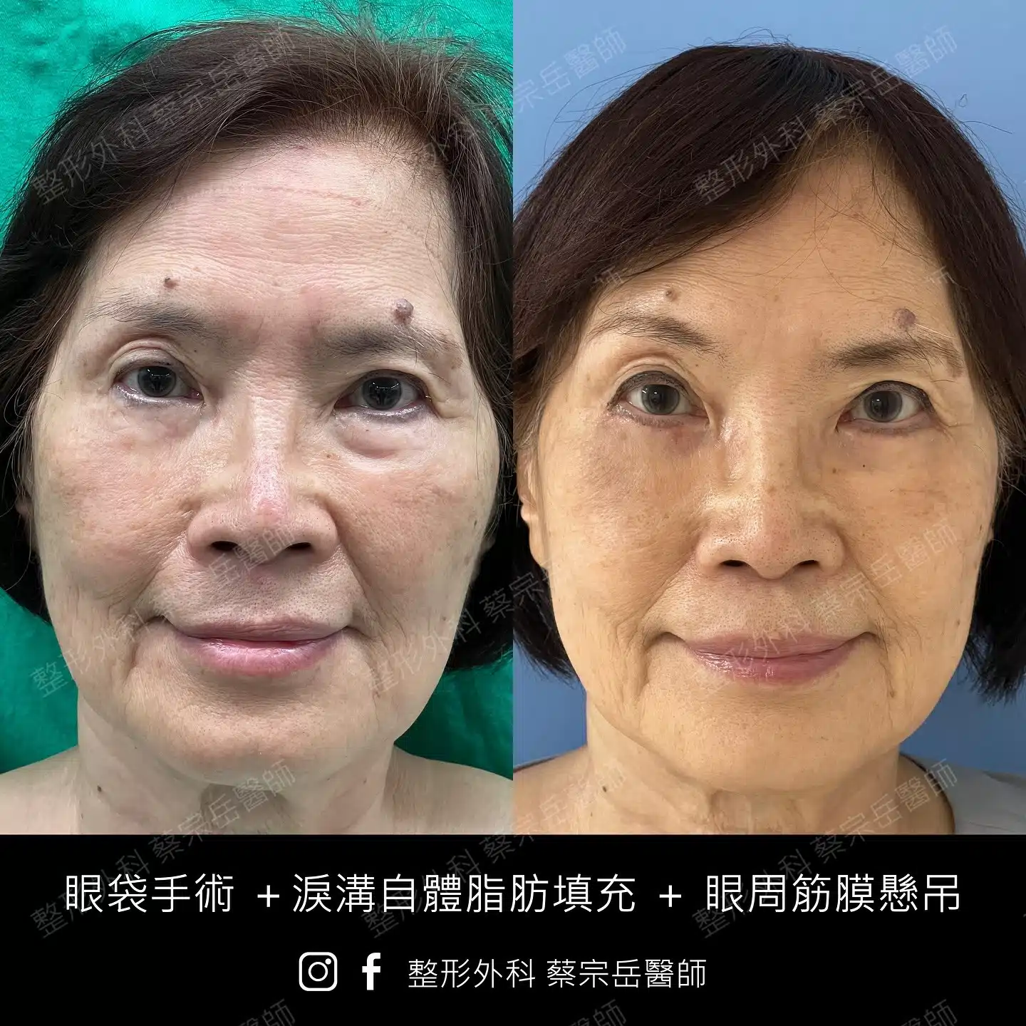 眼袋手術+淚溝自體脂肪填充+眼周筋膜懸吊