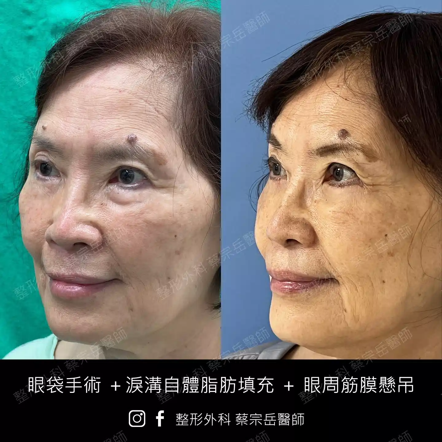 眼袋手術+淚溝自體脂肪填充+眼周筋膜懸吊